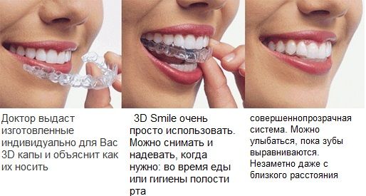 Сколько носить то. Капы на зубы. Система для выравнивания зубов. Выравнивают ли капы зубы. Выравнивание зубов с помощью капы.